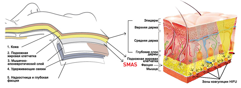 smas